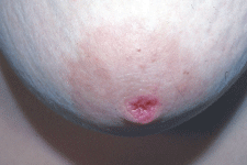 breast-clinical-images-3.gif