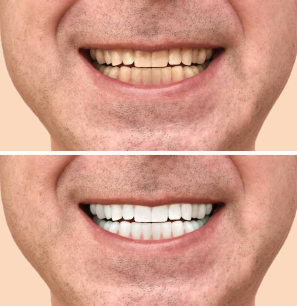 how-to-whitenen-yellow-teeth.jpg