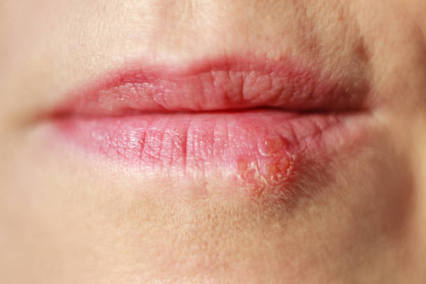  cold-sore-on-the-lips.jpg