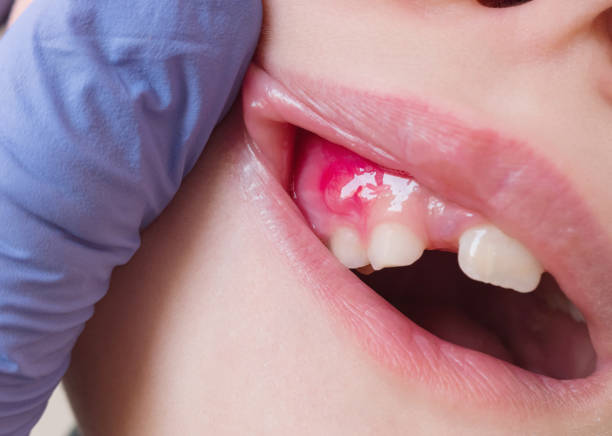  dental-abscess.jpg