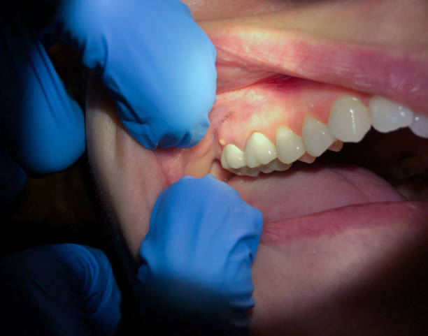 tooth-abscess.jpg