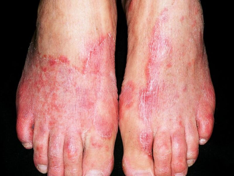  athletes-foot-fungal-infection.jpg